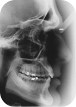 Zdjęcie cefalometryczne (boczne) RTG zębów