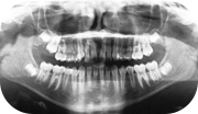 Zdjęcie pantomograficznego (panoramiczne) RTG zębów