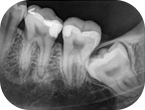 Zdjęcie RTG wewnątrzustne punktowe zęba
